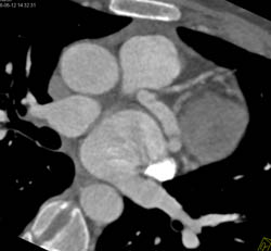 Circumflex Aneurysm - CTisus CT Scan