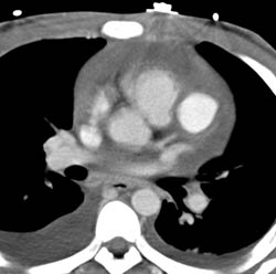 LAD Aneurysm With Hemopericardium - CTisus CT Scan