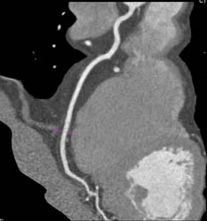 Normal RCA - CTisus CT Scan