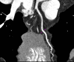 LAD Plaque With 50% Stenosis - CTisus CT Scan