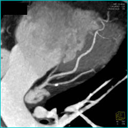 Plaque in LAD - CTisus CT Scan