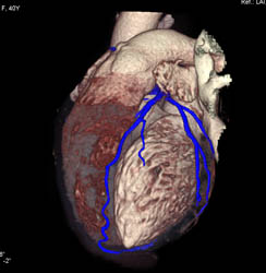 LAD in VRT - CTisus CT Scan