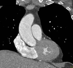 Dilated Ascending Aorta and Thickened Left Ventricle - CTisus CT Scan