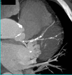 LAD Plaque - CTisus CT Scan