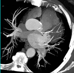 LAD Plaque - CTisus CT Scan