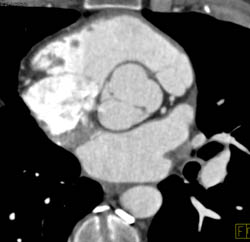 Bicuspid Valve - CTisus CT Scan