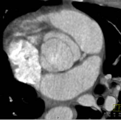 Bicuspid Valve - CTisus CT Scan