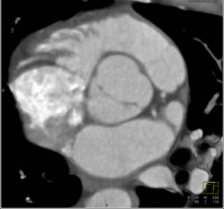 Bicuspid Valve - CTisus CT Scan