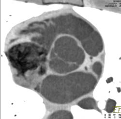 Bicuspid Valve - CTisus CT Scan