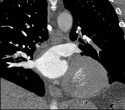 Pulmonary Embolism - CTisus CT Scan