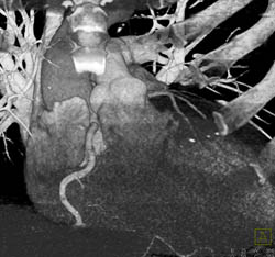 Normal RCA - CTisus CT Scan