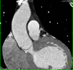 Normal LAD - CTisus CT Scan