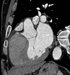 Normal LAD - CTisus CT Scan