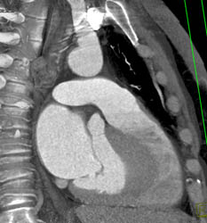 Left Atrium - CTisus CT Scan