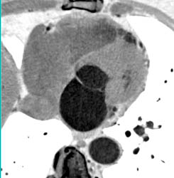 Bicuspid Valve - CTisus CT Scan