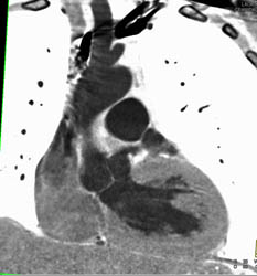 Bicuspid Valve - CTisus CT Scan