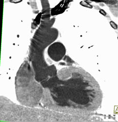 Bicuspid Valve - CTisus CT Scan