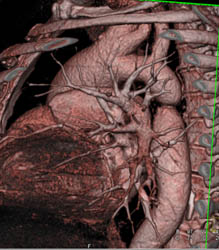 Coarctation of the Aorta - CTisus CT Scan