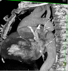 Coarctation of the Aorta - CTisus CT Scan