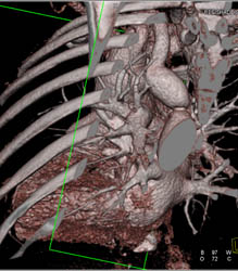 Coarctation of the Aorta - CTisus CT Scan