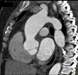 Coarctation of the Aorta - CTisus CT Scan