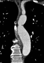 Coarctation of the Aorta - CTisus CT Scan