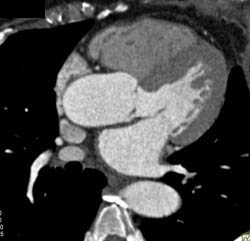 Bicuspid Valve - CTisus CT Scan