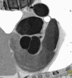 Bicuspid Valve - CTisus CT Scan