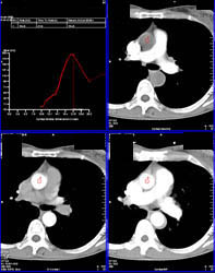 Timing for Coronary Artery Study - CTisus CT Scan