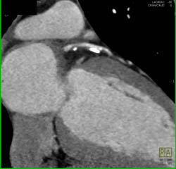 LAD Plaque With Greater Than 50% Stenosis - CTisus CT Scan