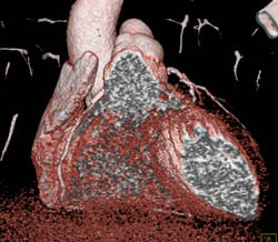 RCA With Plaque - CTisus CT Scan