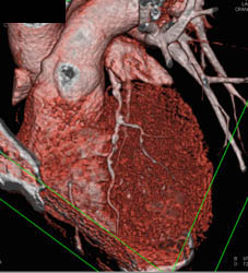 LAD Disease - CTisus CT Scan