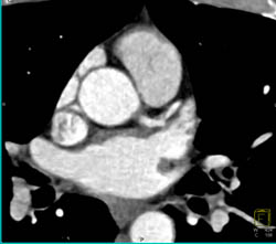 LAD Stenosis - CTisus CT Scan