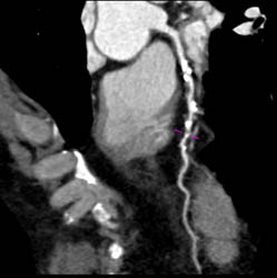 LAD Stenosis - CTisus CT Scan