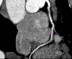 LAD Stenosis - CTisus CT Scan