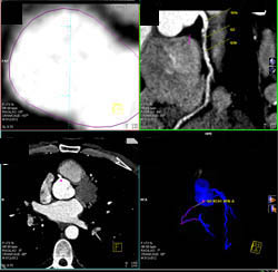 LAD Stenosis - CTisus CT Scan