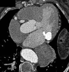 Aneurysm of Circumflex Coronary Artery - CTisus CT Scan