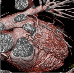 LAD and Circumflex Directly Off Left Cusp - CTisus CT Scan