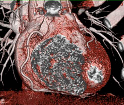 Normal RCA - CTisus CT Scan