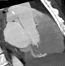 Normal RCA - CTisus CT Scan