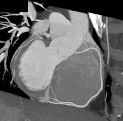 Normal RCA - CTisus CT Scan