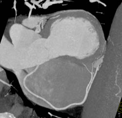 Normal RCA - CTisus CT Scan