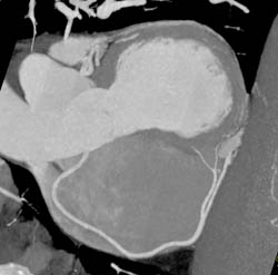 Normal RCA - CTisus CT Scan