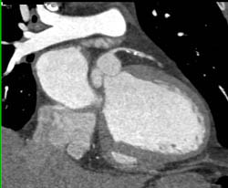 LAD Plaque - CTisus CT Scan