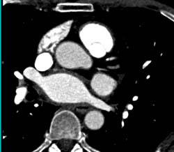 Esophagitis Adjacent to Aorta - CTisus CT Scan