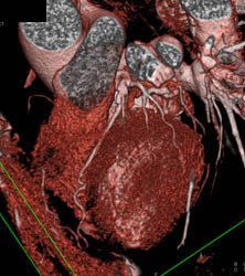 Circumflex Artery Aneurysm - CTisus CT Scan