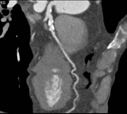 LAD Disease - CTisus CT Scan