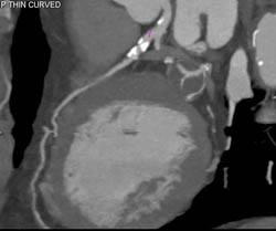 LAD Disease - CTisus CT Scan