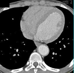 Takayasu's Arteritis With LAD Involvement - CTisus CT Scan