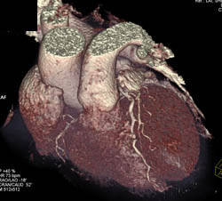 LAD Stenosis - CTisus CT Scan